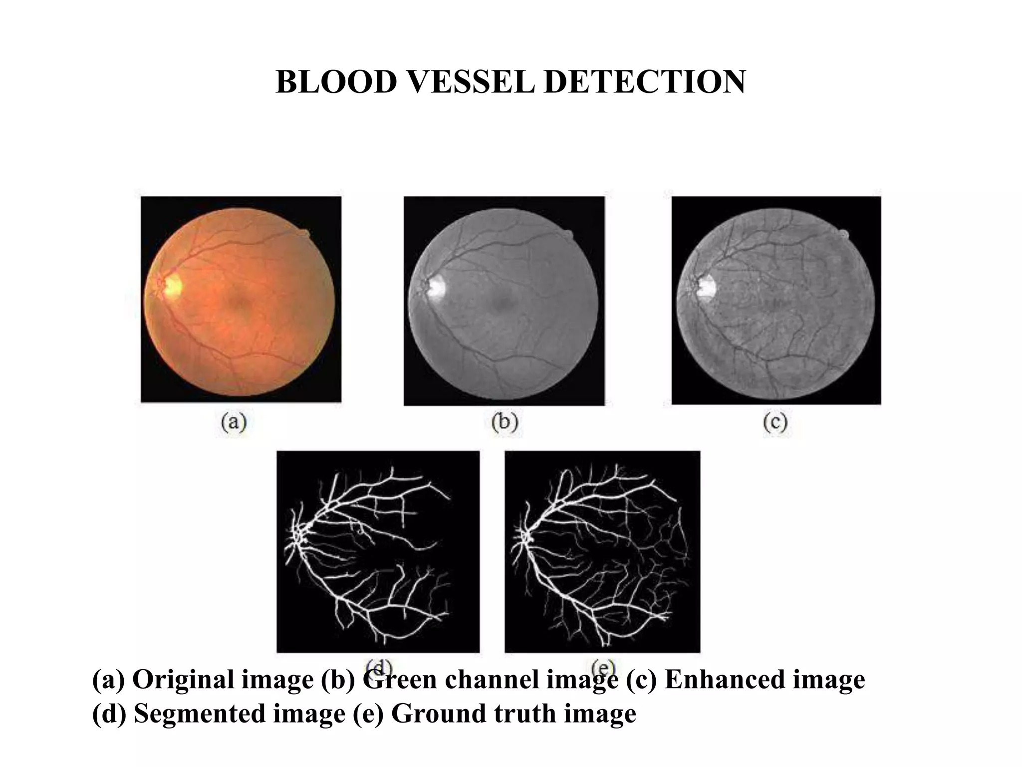 BLOOD VESSEL DETECTION
(a) Original image (b) Green channel image (c) Enhanced image
(d) Segmented image (e) Ground truth image
 