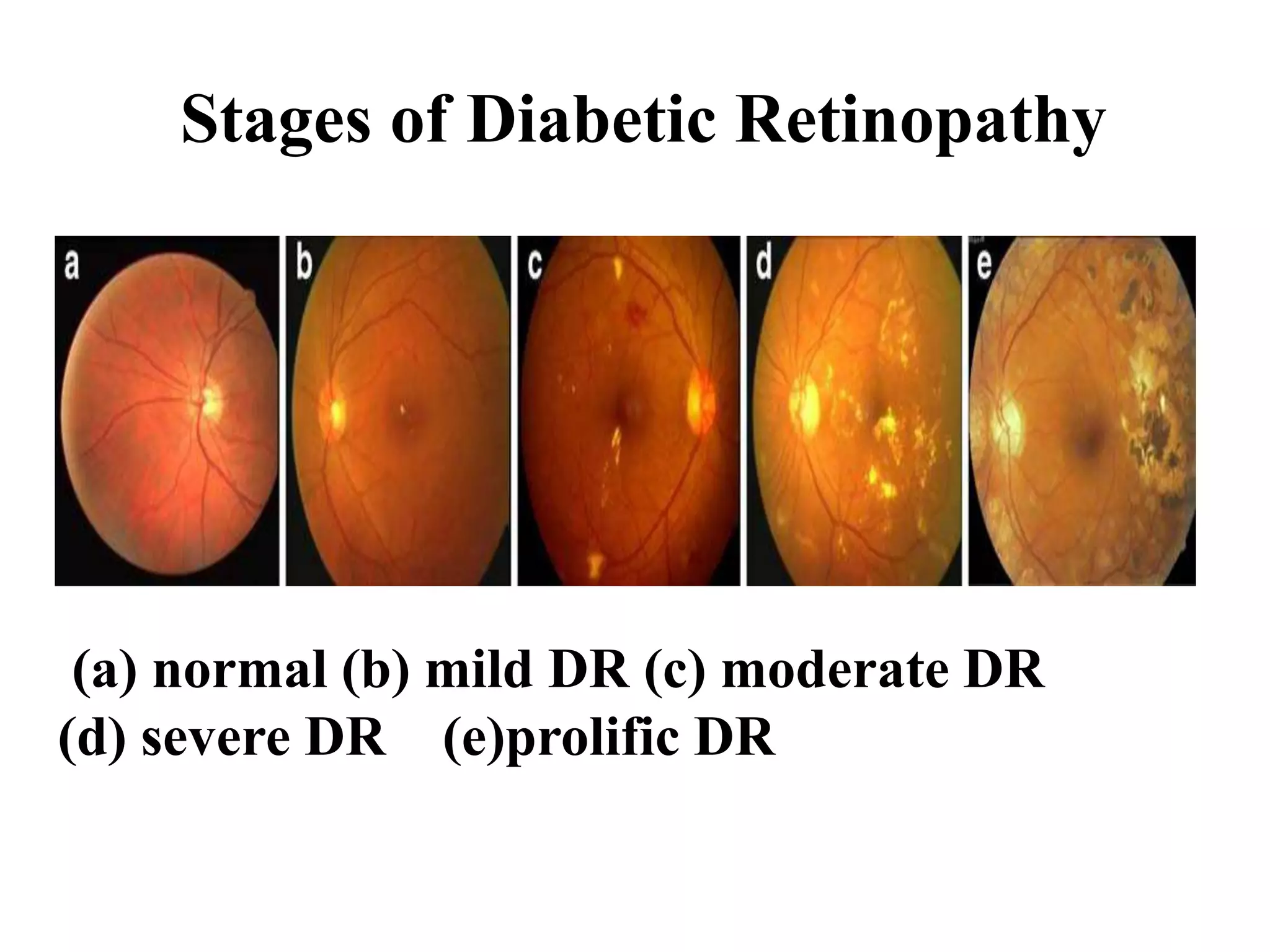 Stages of Diabetic Retinopathy
(a) normal (b) mild DR (c) moderate DR
(d) severe DR (e)prolific DR
 