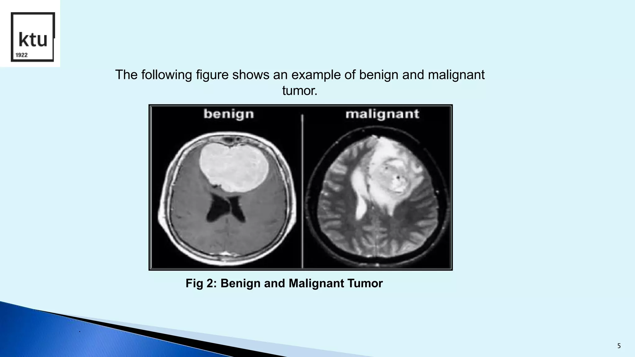 The following figure shows an example of benign and malignant
tumor.
Fig 2: Benign and Malignant Tumor
.
5
 