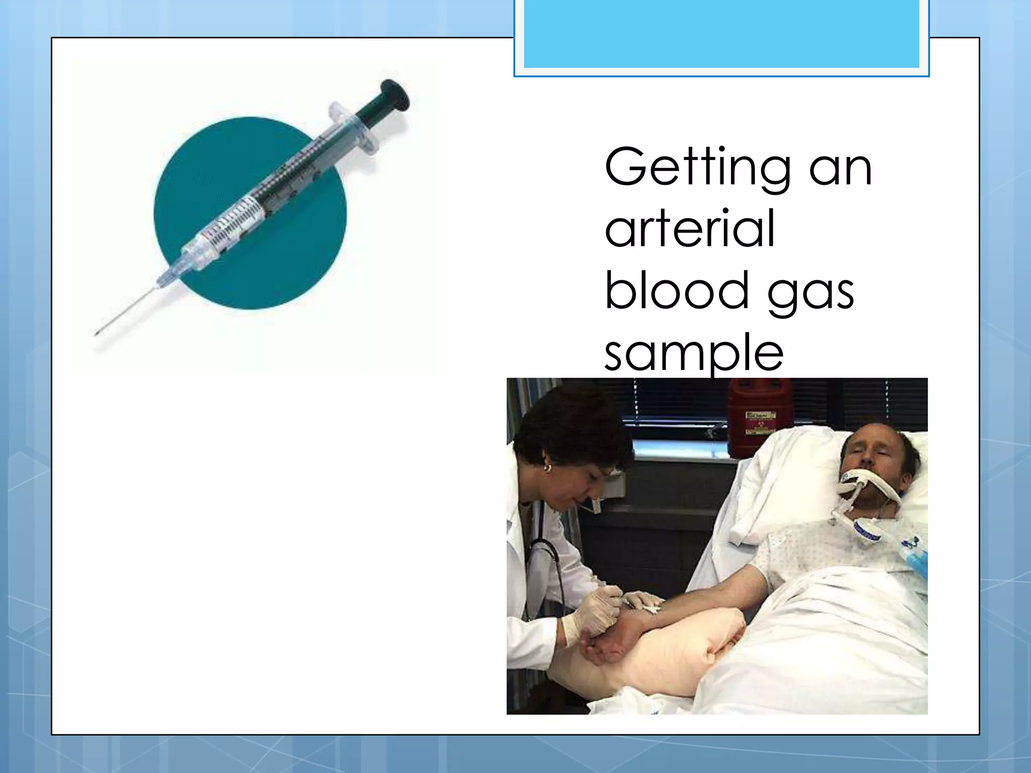 Getting an
arterial
blood gas
sample
 