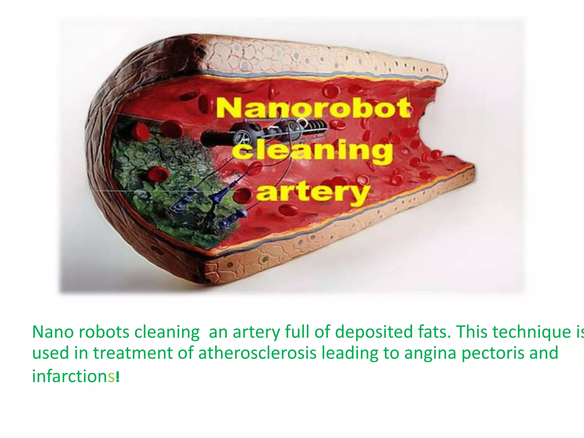 Nano robots cleaning an artery full of deposited fats. This technique is
used in treatment of atherosclerosis leading to angina pectoris and
infarctions!
 
