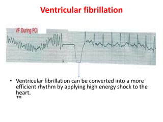 Ventricular fibrillation
• Ventricular fibrillation can be converted into a more
efficient rhythm by applying high energy shock to the
heart.
™
 