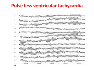 Pulse less ventricular tachycardia
 