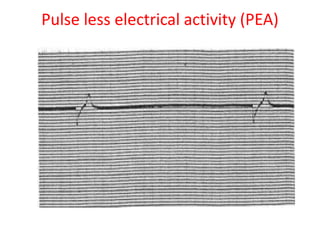 Pulse less electrical activity (PEA)
 