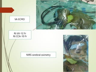 VA ECMO
NIRS cerebral oximetry
Rt IJV-12 Fr
Rt CCA-10 Fr
 