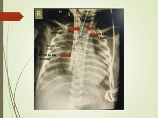 Rt IJV to RA
cannula
Rt Carotid
cannula
ETT
Lt IJV
line
Multiple side
holes
 