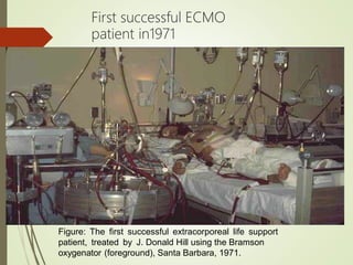 First successful ECMO
patient in1971
Figure: The first successful extracorporeal life support
patient, treated by J. Donald Hill using the Bramson
oxygenator (foreground), Santa Barbara, 1971.
 