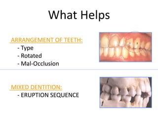 What Helps
ARRANGEMENT OF TEETH:
- Type
- Rotated
- Mal-Occlusion
MIXED DENTITION:
- ERUPTION SEQUENCE
 