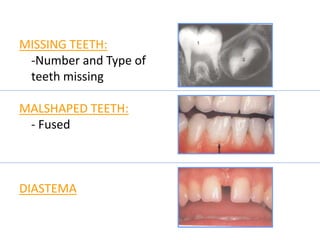 MISSING TEETH:
-Number and Type of
teeth missing
MALSHAPED TEETH:
- Fused
DIASTEMA
 