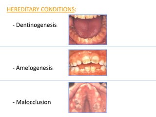 HEREDITARY CONDITIONS:
- Dentinogenesis
- Amelogenesis
- Malocclusion
 