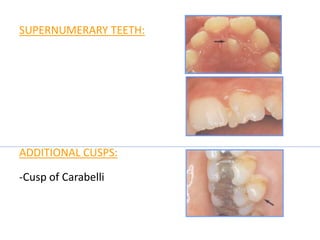SUPERNUMERARY TEETH:
ADDITIONAL CUSPS:
-Cusp of Carabelli
 