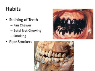 Habits
• Staining of Teeth
– Pan Chewer
– Betel Nut Chewing
– Smoking
• Pipe Smokers
 