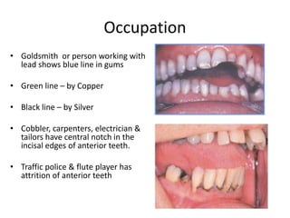 Occupation
• Goldsmith or person working with
lead shows blue line in gums
• Green line – by Copper
• Black line – by Silver
• Cobbler, carpenters, electrician &
tailors have central notch in the
incisal edges of anterior teeth.
• Traffic police & flute player has
attrition of anterior teeth
 