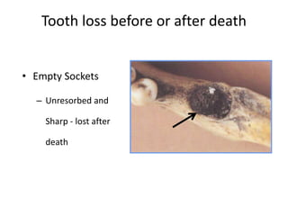 Tooth loss before or after death
• Empty Sockets
– Unresorbed and
Sharp - lost after
death
 