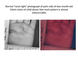 Normal “room light” photograph of palm side of two-month-old
infant victim of child abuse; bite mark pattern is almost
indiscernable
 