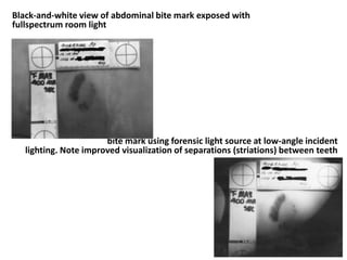 Black-and-white view of abdominal bite mark exposed with
fullspectrum room light
bite mark using forensic light source at low-angle incident
lighting. Note improved visualization of separations (striations) between teeth
 