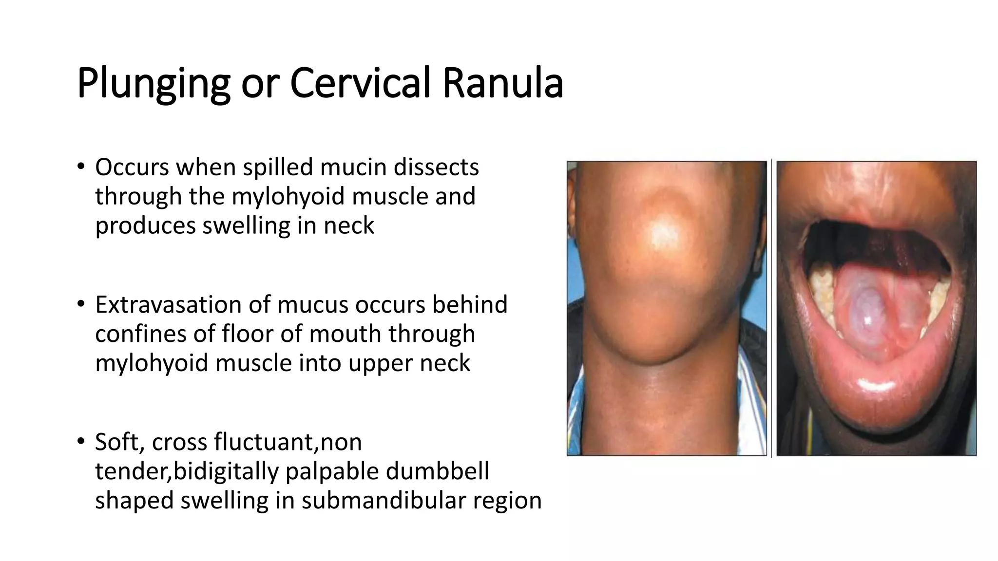 Final ppt neck swelling.pptx