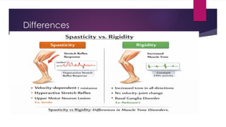 Understanding Spasticity and Rigidity: Neurophysiology, Clinical ...