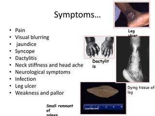 Symptoms… 
• Pain 
• Visual blurring 
• jaundice 
• Syncope 
• Dactylitis 
• Neck stiffness and head ache 
• Neurological symptoms 
• Infection 
• Leg ulcer 
• Weakness and pallor 
Dactylit 
is 
Leg 
ulcer 
Small remnant 
of 
spleen 
Dying tissue of 
leg 
 