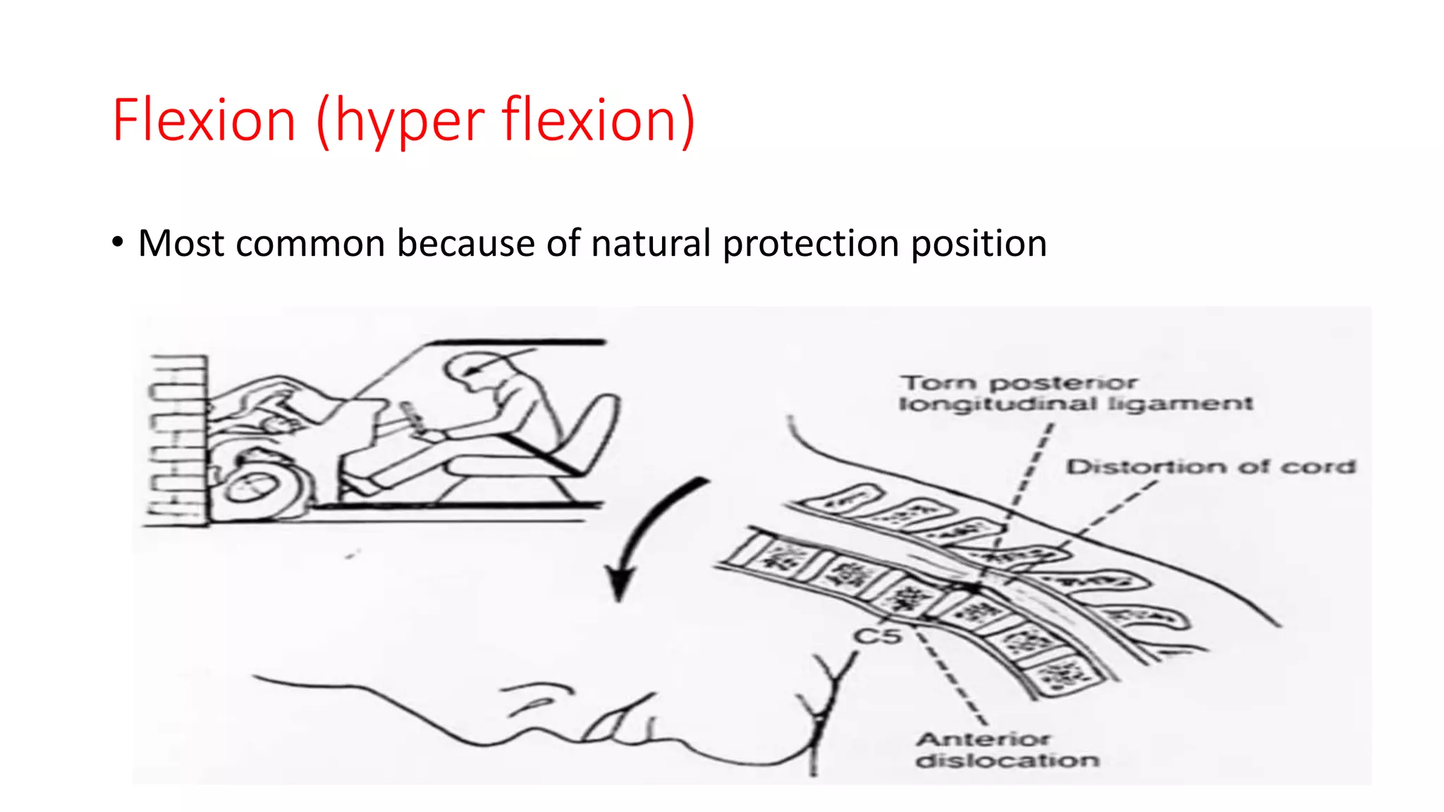 Hyperflexion Example Spinal cord disorders.pptx