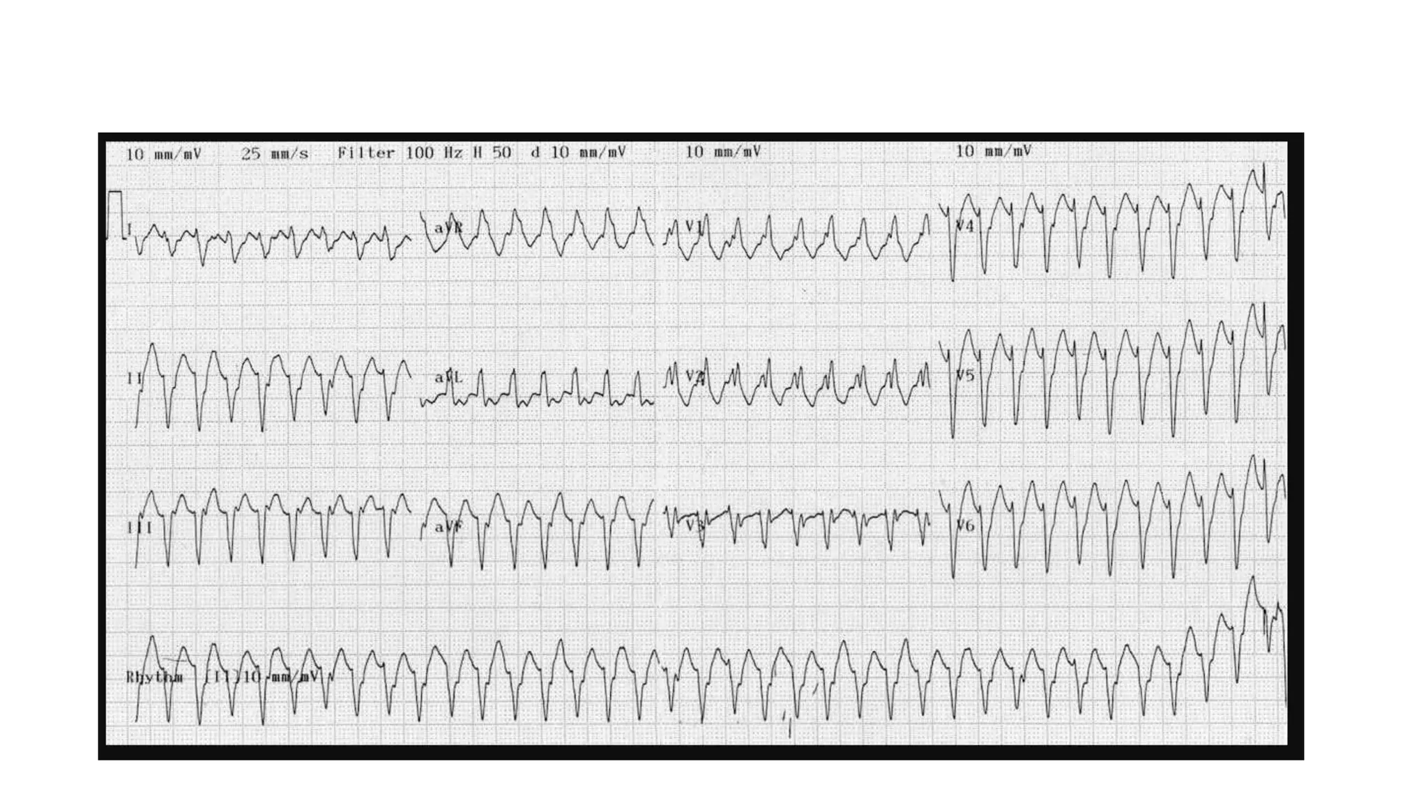 wide complex tachycardia.pptx