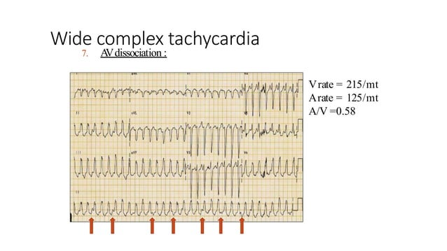 wide complex tachycardia.pptx