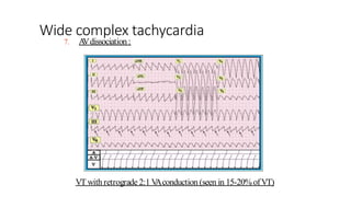 Wide Complex Vt wide complex tachycardia.pptx