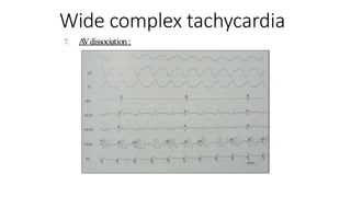 7. A
Vdissociation :
Wide complex tachycardia
 