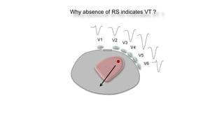V1 V2
V3
V4
V5
V6
Why absence of RS indicates VT ?
 