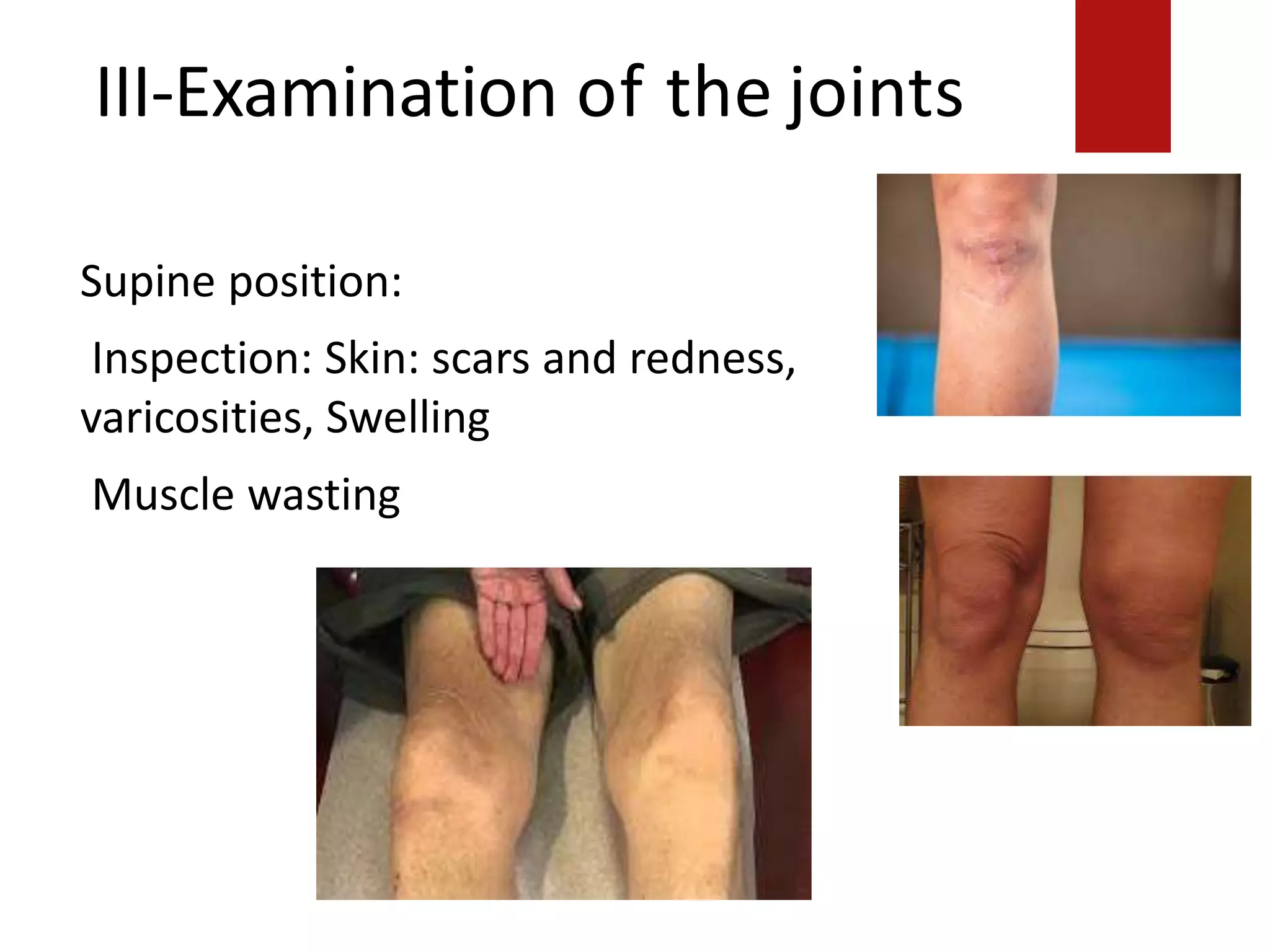 III-Examination of the joints
aricositie.
Supine position:
Supine position:
Inspection: Skin: scars and redness,
varicosities, Swelling
Muscle wastingection: Skin: scars and
redness, v
Swelling:
Muscle wasting:
VMO
 