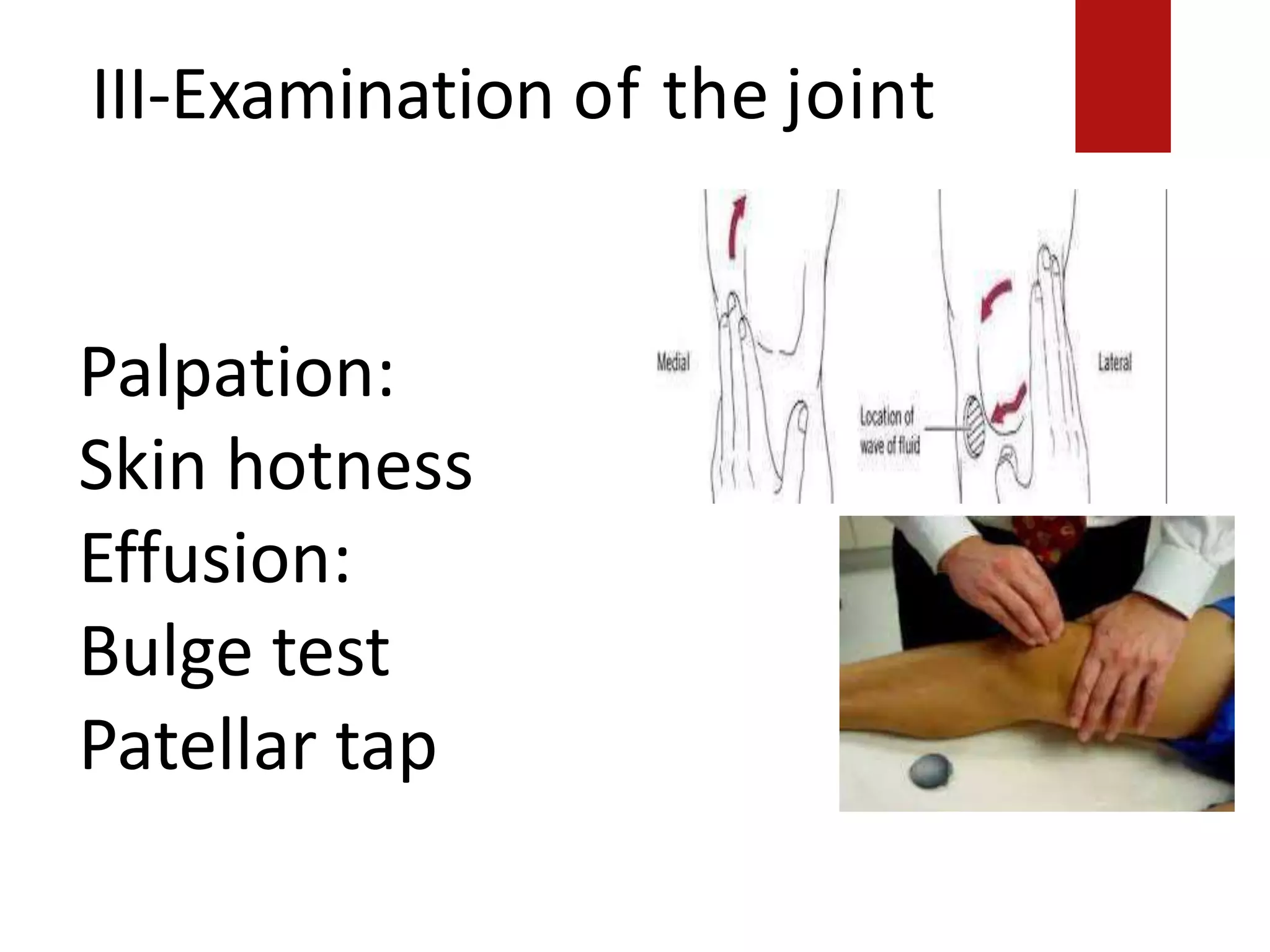 III-Examination of the joint
2-Palpation:
Skin hotness.
Palpation:
Skin hotness
Effusion:
Bulge test
Patellar tap
Effusion: Bulge test
Patellar tap
 