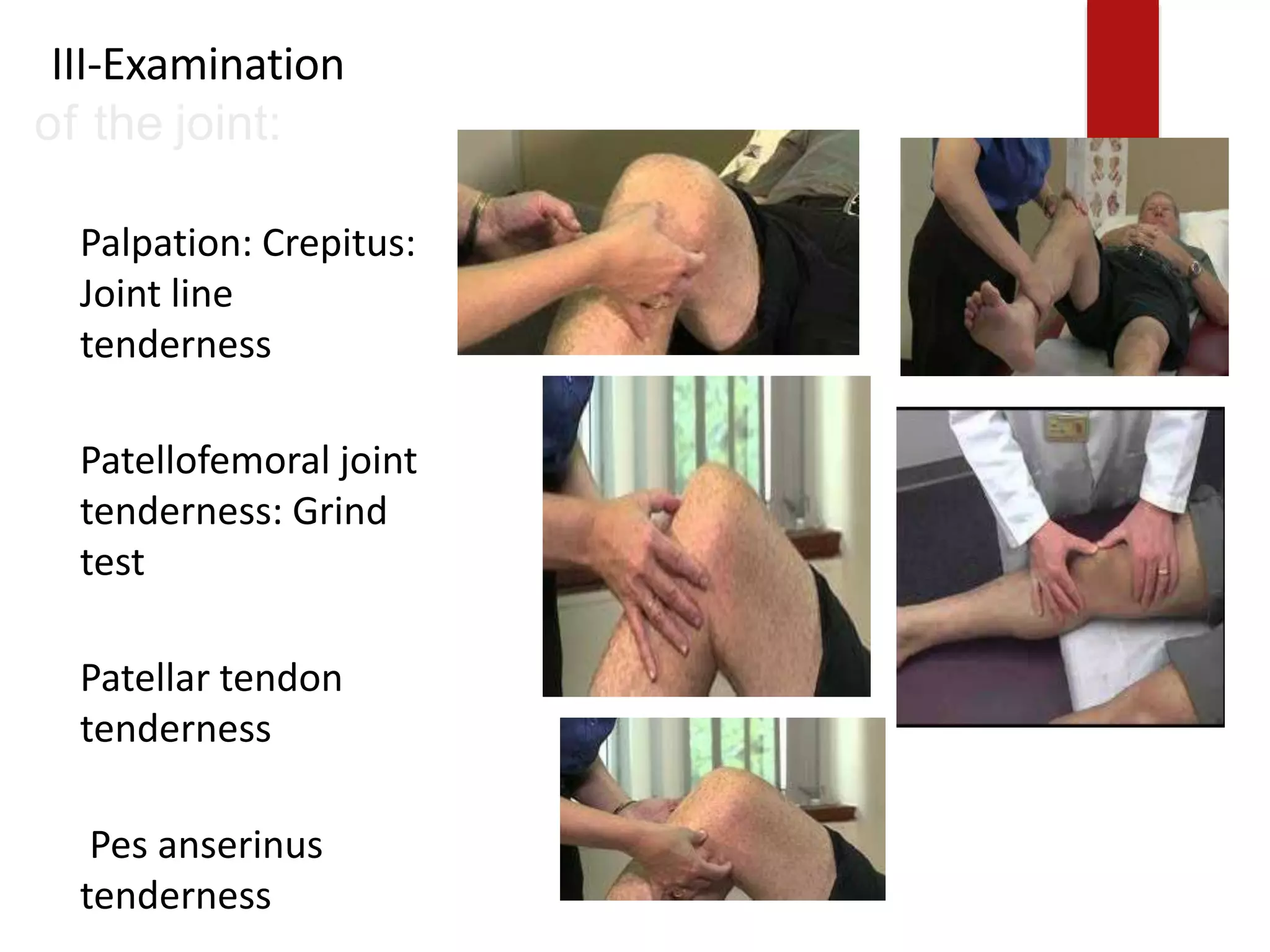 III-Examination
of the joint:
Palpation: Crepitus:
Joint line
tenderness
Patellofemoral joint
tenderness: Grind
test
Patellar tendon
tenderness
Pes anserinus
tenderness
 