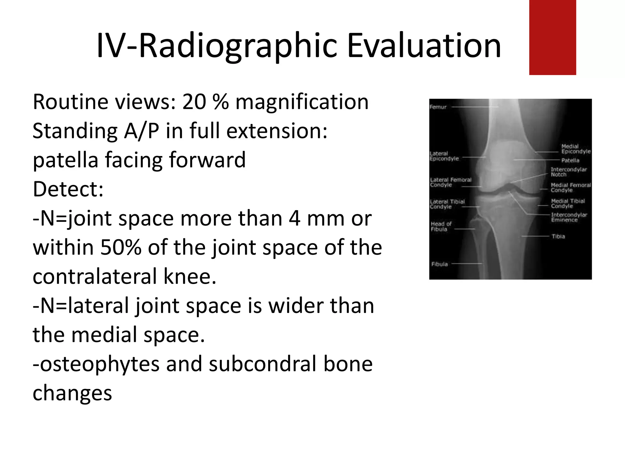 IV-Radiographic Evaluation
Routine views: 20 % magnification
Standing A/P in full extension:
patella facing forward
Detect:
-N=joint space more than 4 mm or
within 50% of the joint space of the
contralateral knee.
-N=lateral joint space is wider than
the medial space.
-osteophytes and subcondral bone
changes
 