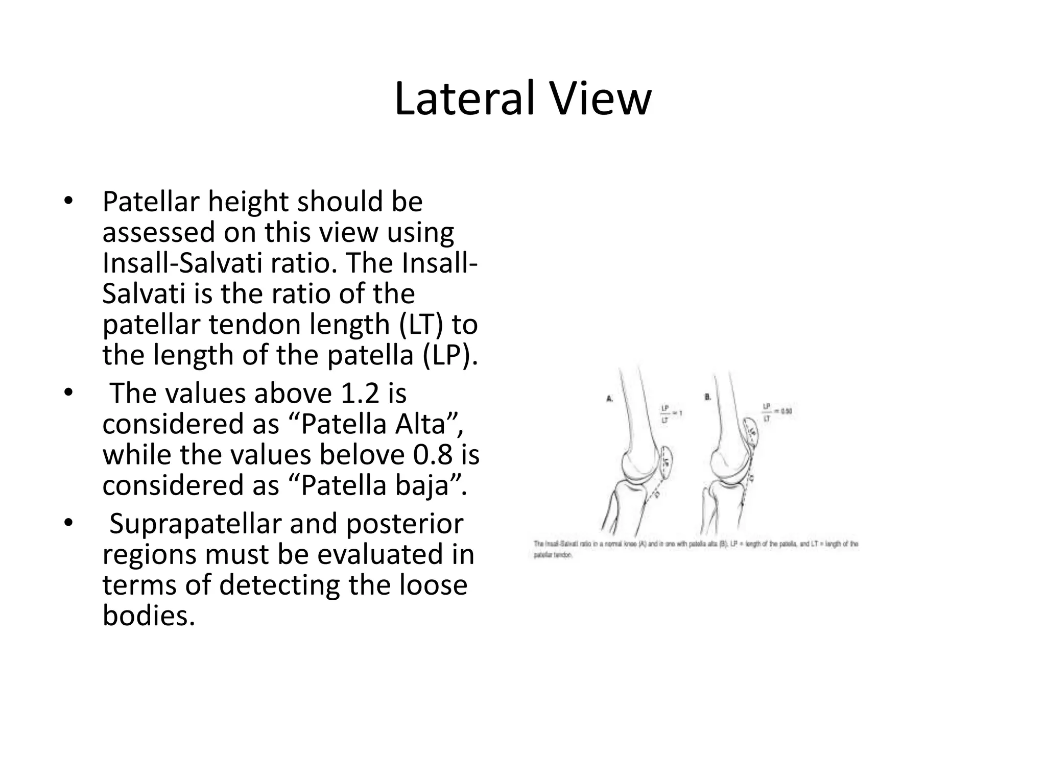 Lateral View
• Patellar height should be
assessed on this view using
Insall-Salvati ratio. The Insall-
Salvati is the ratio of the
patellar tendon length (LT) to
the length of the patella (LP).
• The values above 1.2 is
considered as “Patella Alta”,
while the values belove 0.8 is
considered as “Patella baja”.
• Suprapatellar and posterior
regions must be evaluated in
terms of detecting the loose
bodies.
 