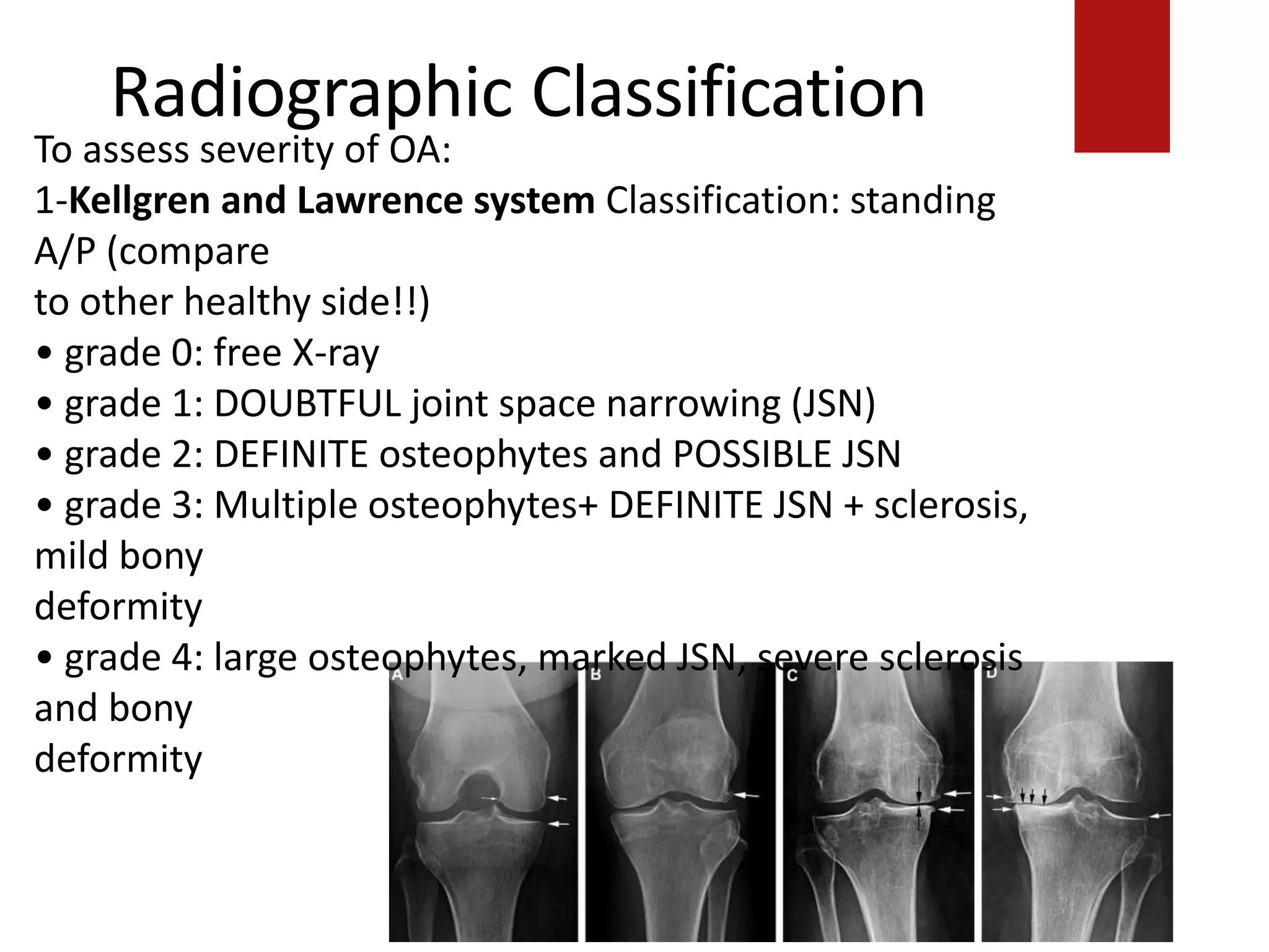 Radiographic Classification
To assess severity of OA:
1-Kellgren and Lawrence system Classification: standing
A/P (compare
to other healthy side!!)
• grade 0: free X-ray
• grade 1: DOUBTFUL joint space narrowing (JSN)
• grade 2: DEFINITE osteophytes and POSSIBLE JSN
• grade 3: Multiple osteophytes+ DEFINITE JSN + sclerosis,
mild bony
deformity
• grade 4: large osteophytes, marked JSN, severe sclerosis
and bony
deformity
 