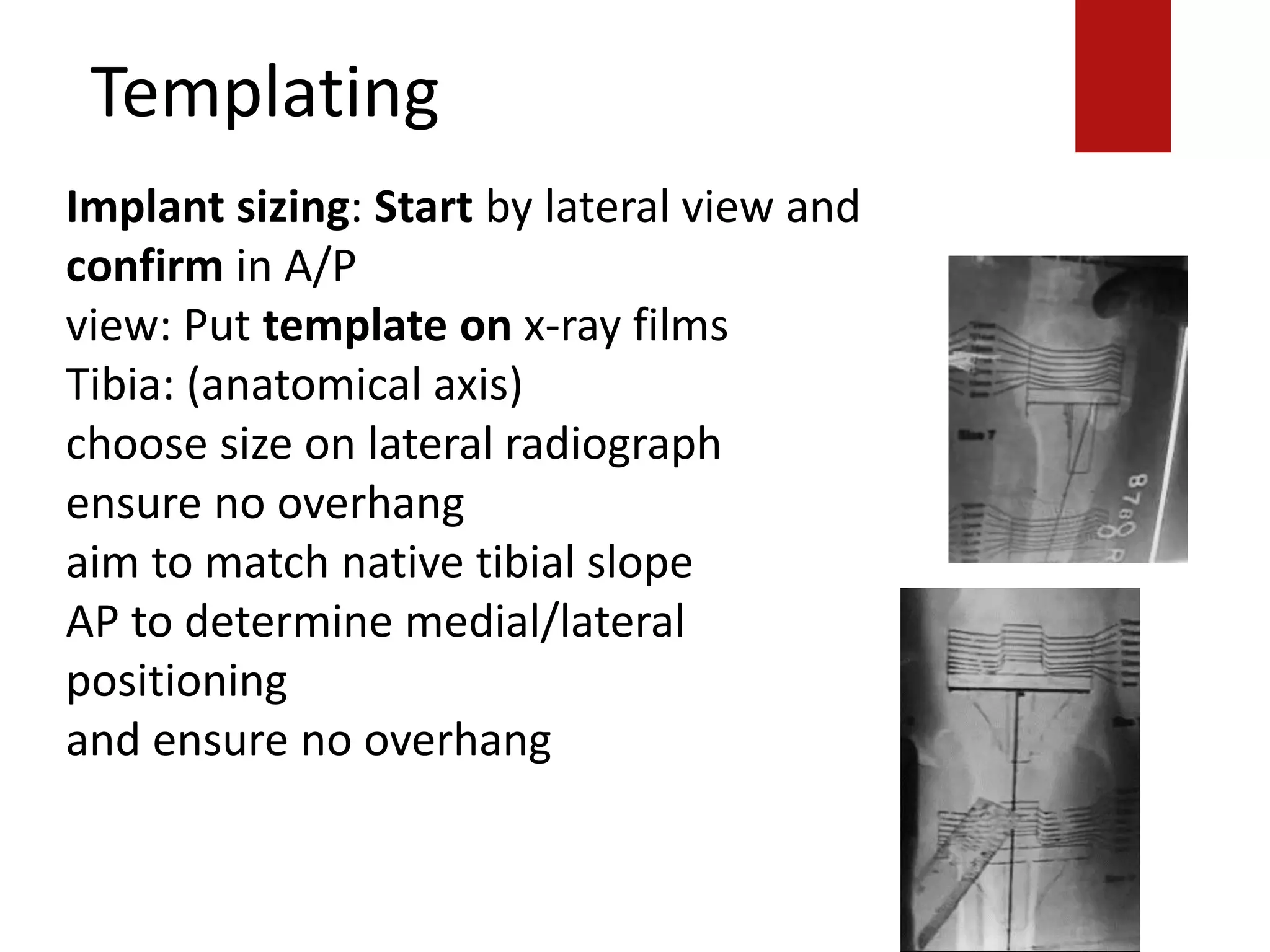 Templating
Implant sizing: Start by lateral view and
confirm in A/P
view: Put template on x-ray films
Tibia: (anatomical axis)
choose size on lateral radiograph
ensure no overhang
aim to match native tibial slope
AP to determine medial/lateral
positioning
and ensure no overhang
 