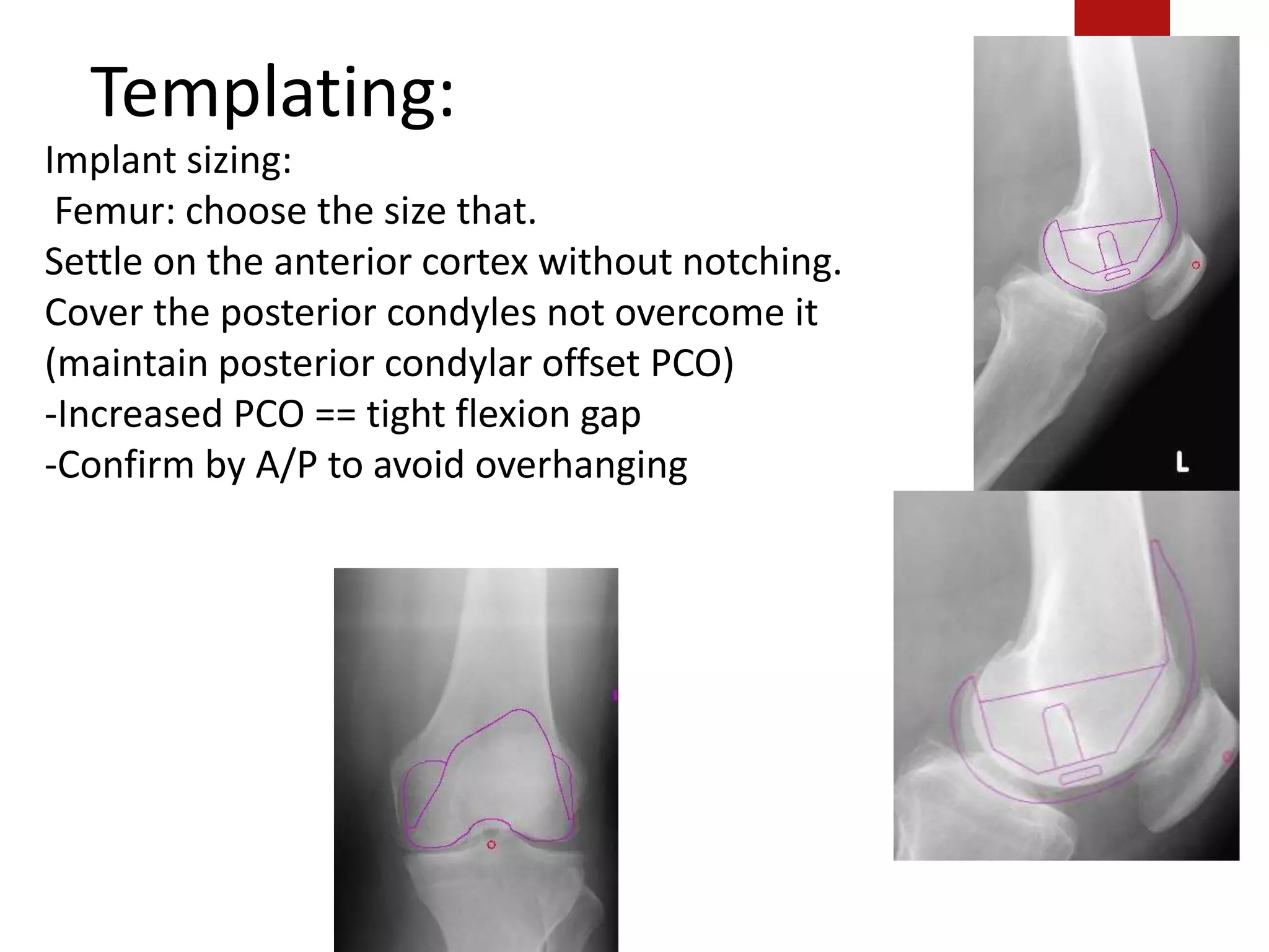Templating:
Implant sizing:
Femur: choose the size that.
Settle on the anterior cortex without notching.
Cover the posterior condyles not overcome it
(maintain posterior condylar offset PCO)
-Increased PCO == tight flexion gap
-Confirm by A/P to avoid overhanging
 
