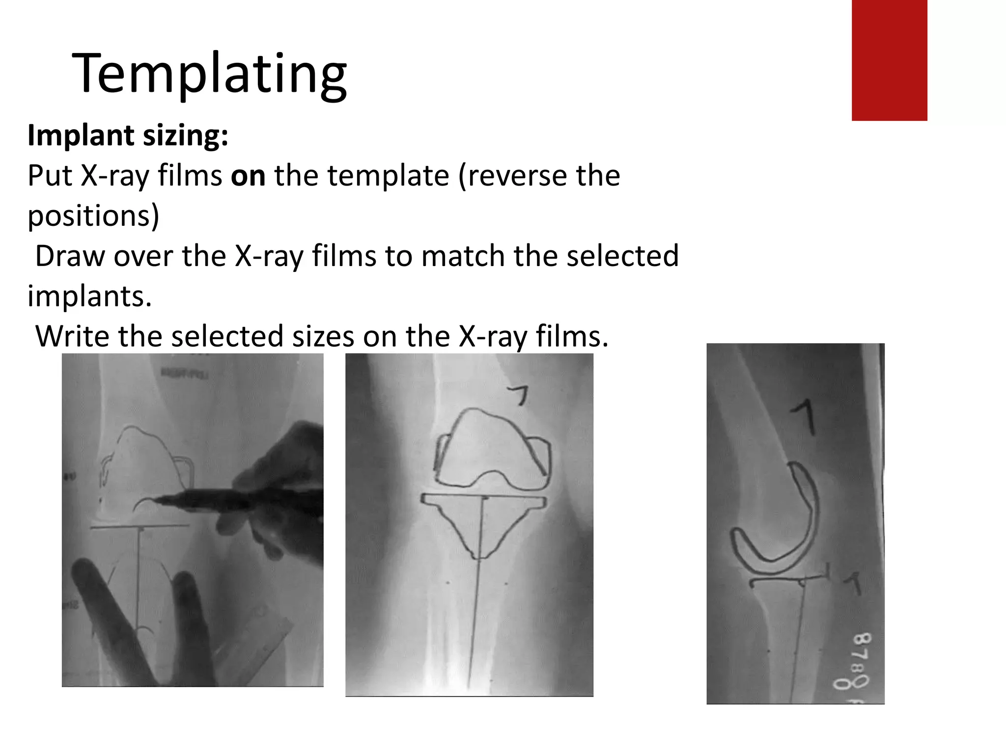 Templating
Implant sizing:
Put X-ray films on the template (reverse the
positions)
Draw over the X-ray films to match the selected
implants.
Write the selected sizes on the X-ray films.
 
