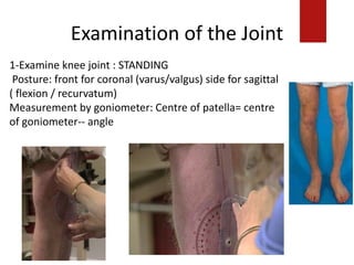 Examination of the Joint
1-Examine knee joint : STANDING
Posture: front for coronal (varus/valgus) side for sagittal
( flexion / recurvatum)
Measurement by goniometer: Centre of patella= centre
of goniometer-- angle
 