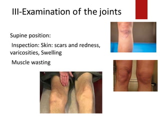 III-Examination of the joints
aricositie.
Supine position:
Supine position:
Inspection: Skin: scars and redness,
varicosities, Swelling
Muscle wastingection: Skin: scars and
redness, v
Swelling:
Muscle wasting:
VMO
 