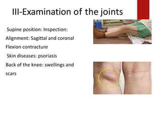 III-Examination of the joints
Supine position: Inspection:
iSupine position: Inspection:
Alignment: Sagittal and coronal
Flexion contracture
Skin diseases: psoriasis
Back of the knee: swellings and
scarsnment: Sagittal and coronal
Flexion contracture
Skin diseases: psoriasis.
Back of the knee: swellings and scars
 