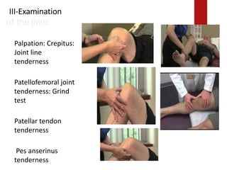 III-Examination
of the joint:
Palpation: Crepitus:
Joint line
tenderness
Patellofemoral joint
tenderness: Grind
test
Patellar tendon
tenderness
Pes anserinus
tenderness
 