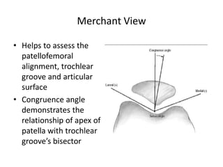 Merchant View
• Helps to assess the
patellofemoral
alignment, trochlear
groove and articular
surface
• Congruence angle
demonstrates the
relationship of apex of
patella with trochlear
groove’s bisector
 