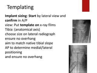 Templating
Implant sizing: Start by lateral view and
confirm in A/P
view: Put template on x-ray films
Tibia: (anatomical axis)
choose size on lateral radiograph
ensure no overhang
aim to match native tibial slope
AP to determine medial/lateral
positioning
and ensure no overhang
 