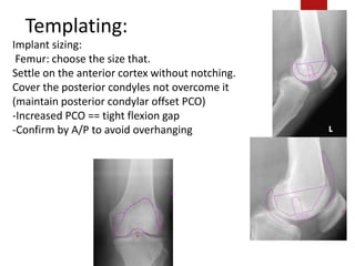 Templating:
Implant sizing:
Femur: choose the size that.
Settle on the anterior cortex without notching.
Cover the posterior condyles not overcome it
(maintain posterior condylar offset PCO)
-Increased PCO == tight flexion gap
-Confirm by A/P to avoid overhanging
 