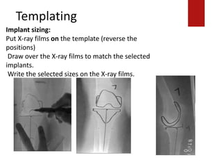 Templating
Implant sizing:
Put X-ray films on the template (reverse the
positions)
Draw over the X-ray films to match the selected
implants.
Write the selected sizes on the X-ray films.
 
