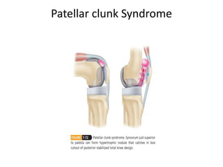 Patellar clunk Syndrome
 