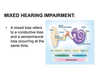 MIXED HEARING IMPAIRMENT:
• A mixed loss refers
to a conductive loss
and a sensorineural
loss occurring at the
same time.
 