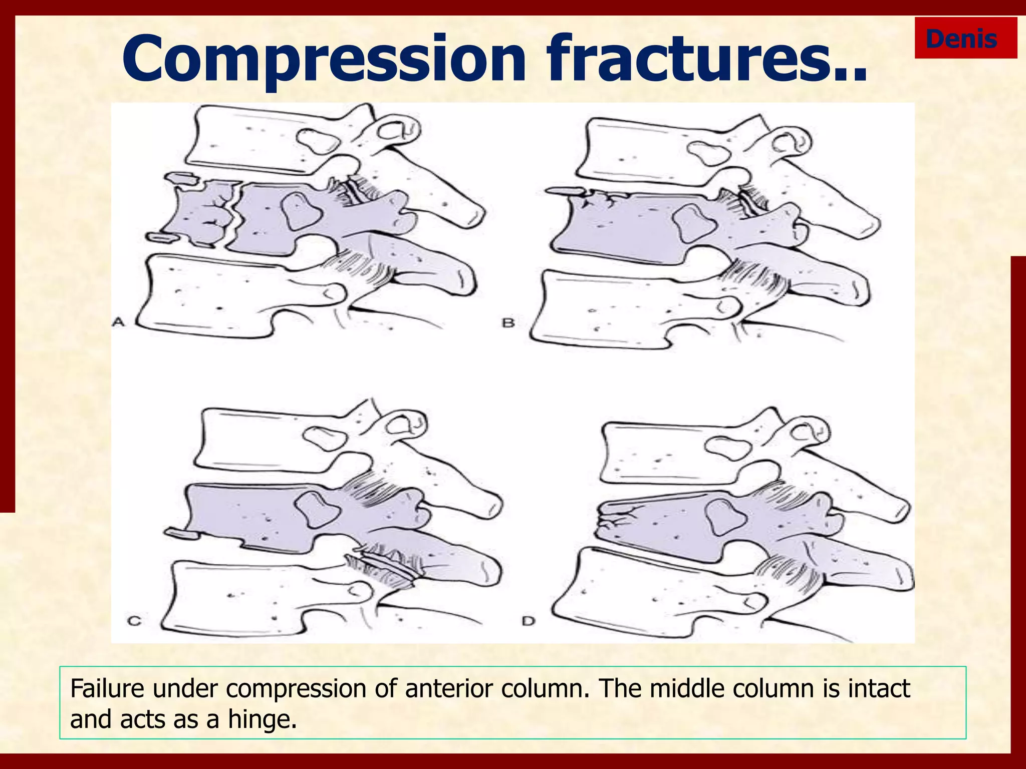 thoracolumbar spinal trauma | PPTX