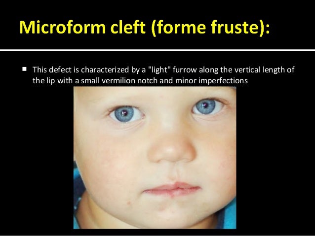 lec 3 embryology development of the maxillofacial complex bilateral cleft lip
